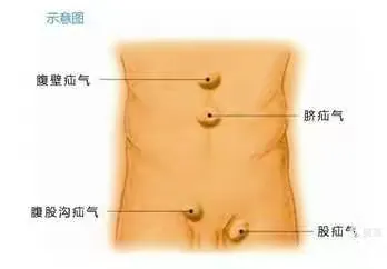 疝是什么？得了疝气怎么了？是微创还是开刀？什么时候作合适？